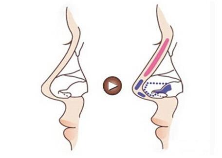隆鼻手术后有哪些后遗症呢？