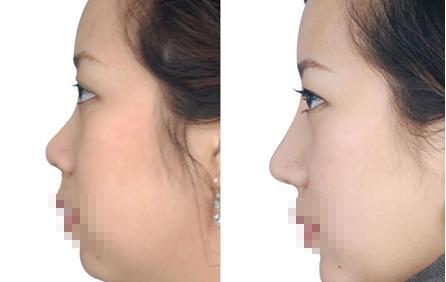 假体隆鼻效果怎么样？手术过程是如何进行？