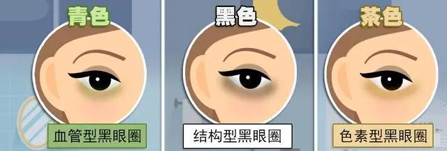 怎么判断黑眼圈是什么类型的，黑眼圈应该怎么改善效果最好