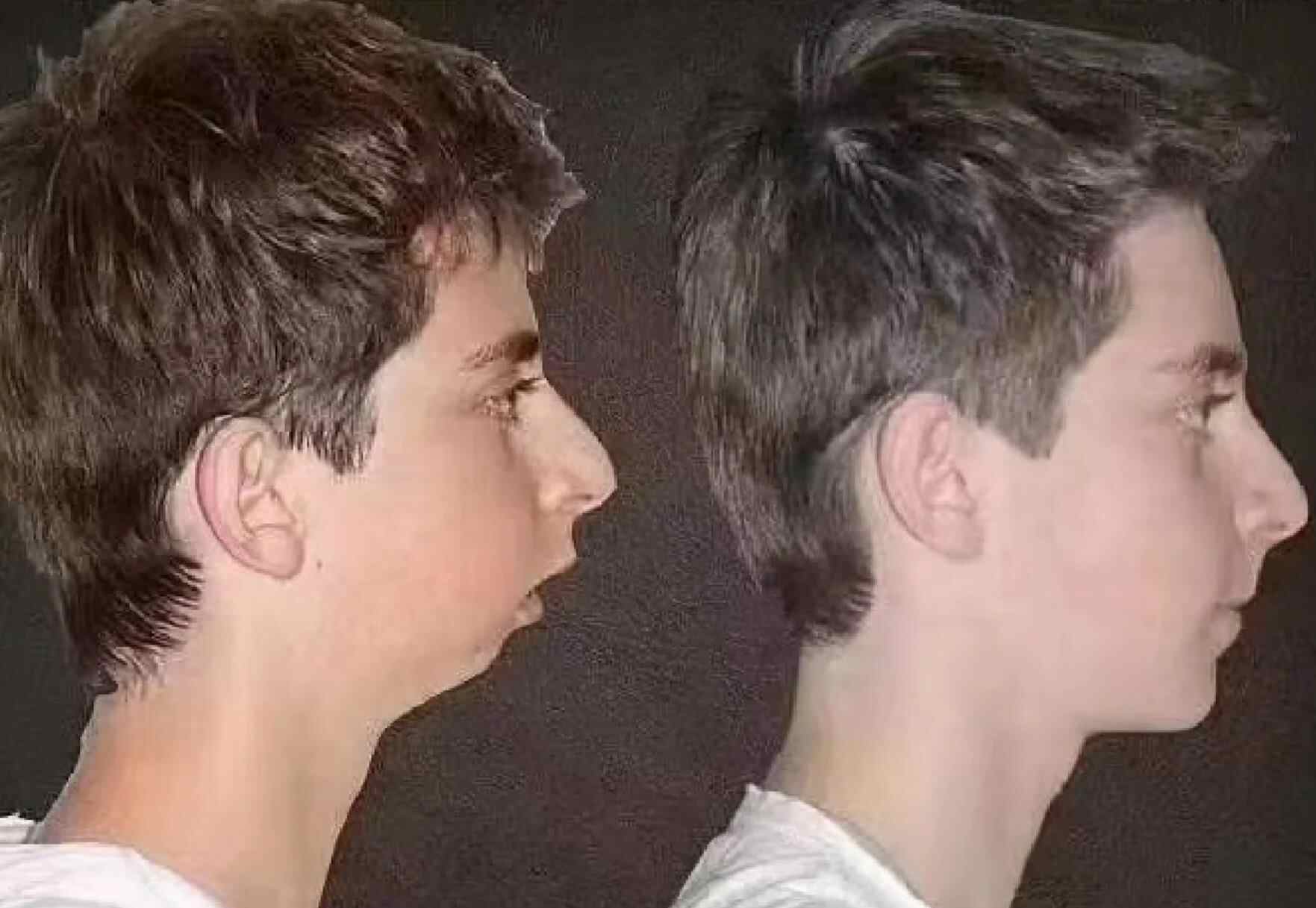 腺样体面容图片对比图，腺样体面容图片